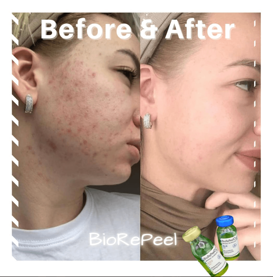 Bio RePeel Acne Before and After