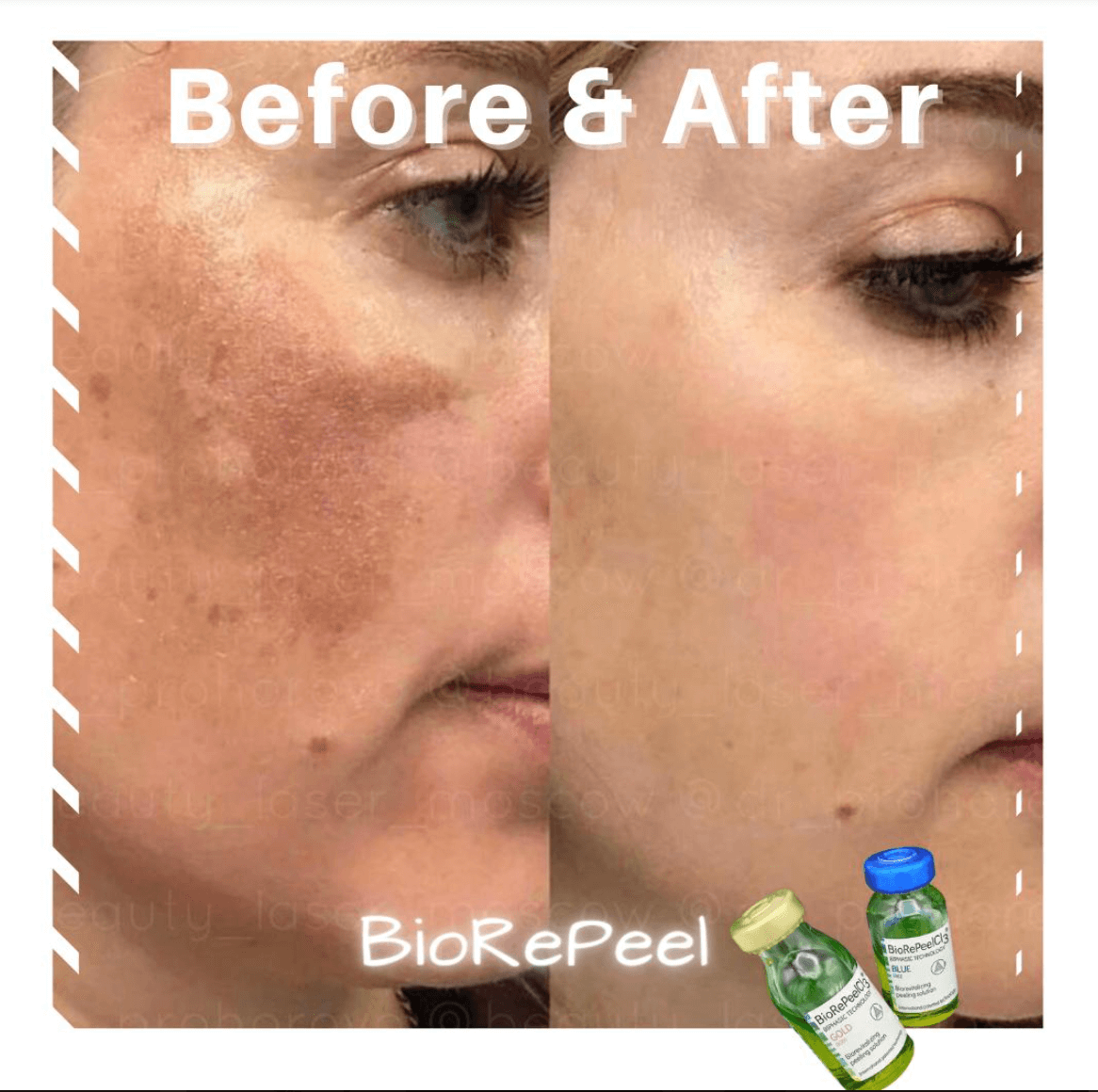 Bio RePeel Hyperpigmentation Before and After