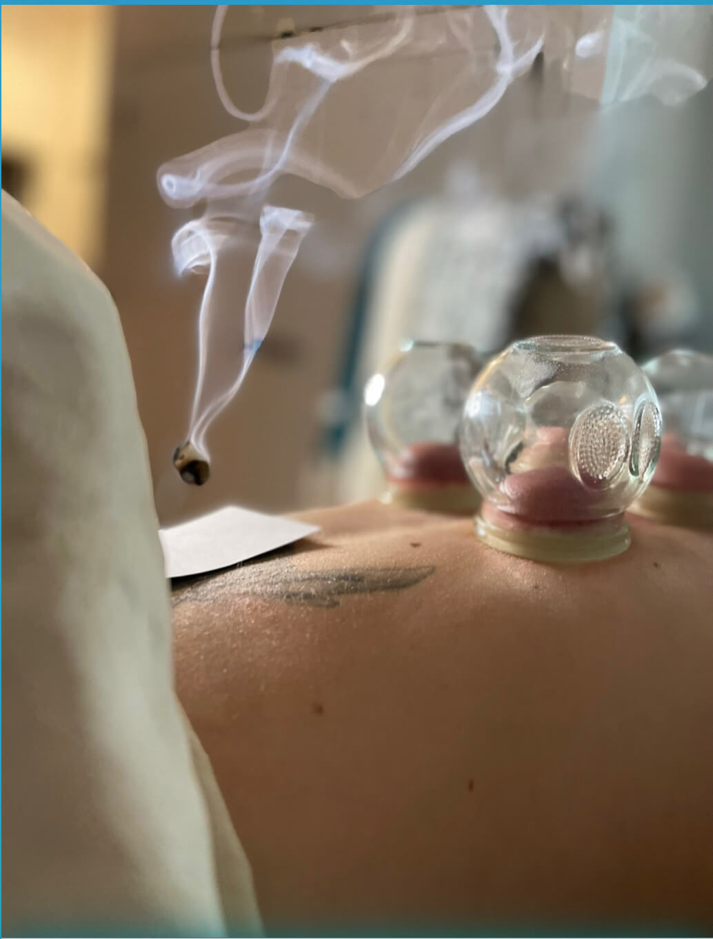 Lindsey-Fire-cupping-2-