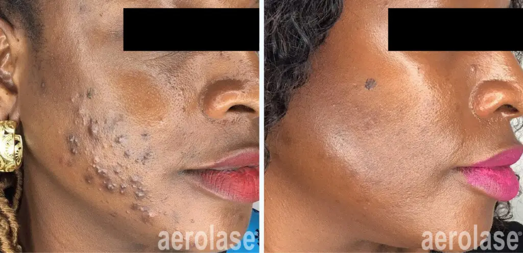 111acne cheeks sholema skinofcolor before and after 2