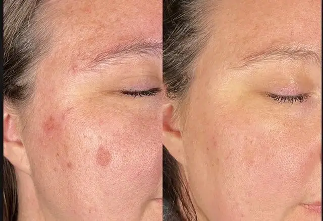 Aerolase neo for Melasma And Hyperpigmentation