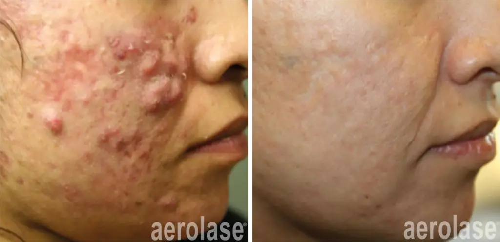 aerolase michael gold acne 5 treatments