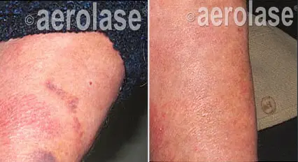 Aerolase Laser Rosacea Psoriasis Relief