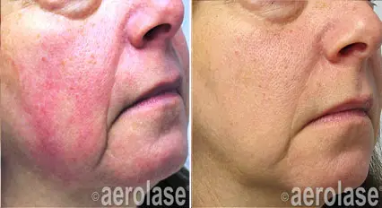 Aerolase Laser Rosacea Psoriasis Relief