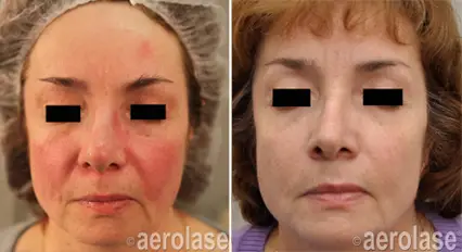 Aerolase Laser Rosacea Psoriasis Relief