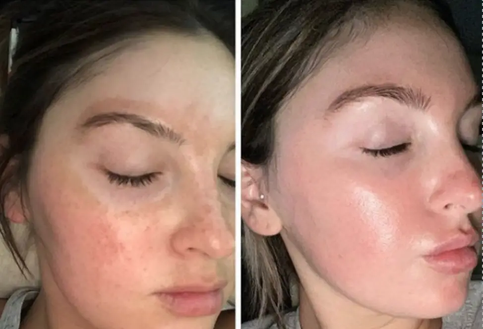 Aerolase neo for Melasma And Hyperpigmentation