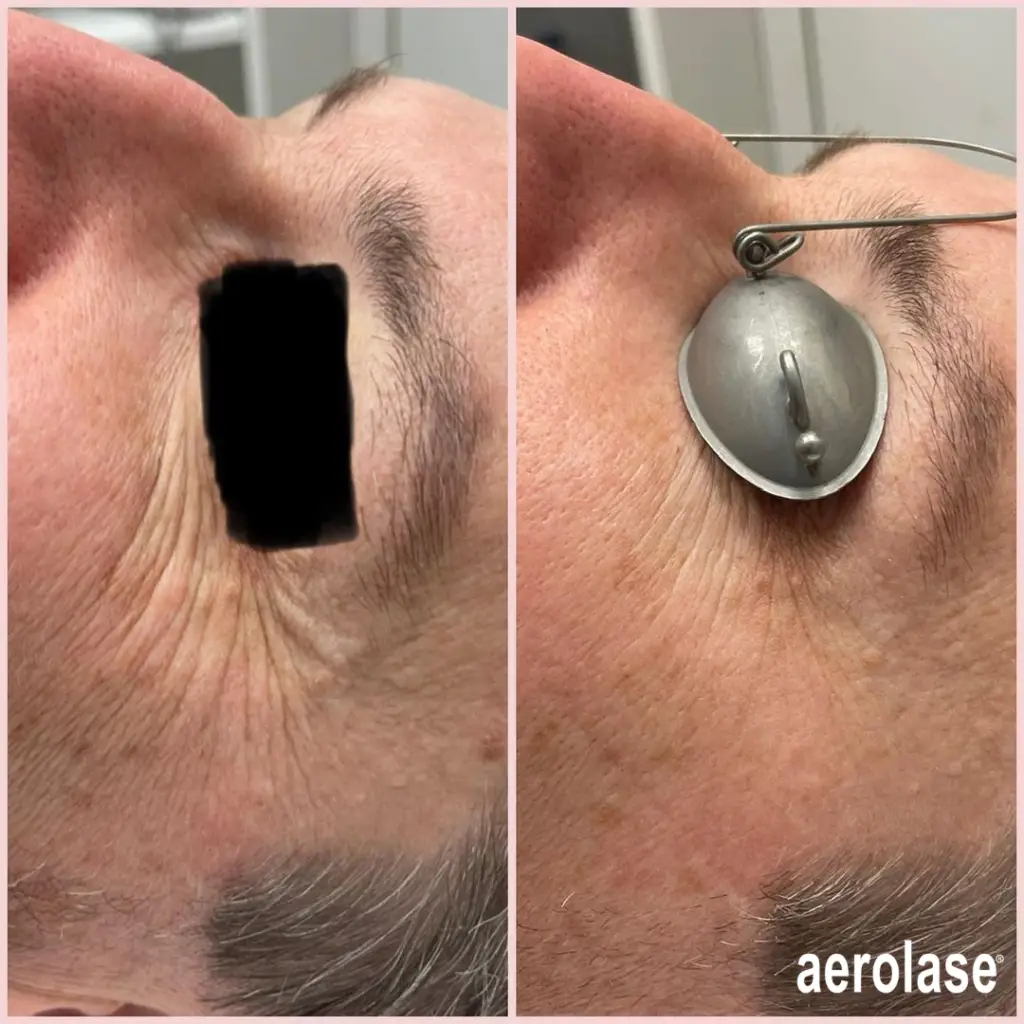 Aerolase Neo For Rejuvenation Tightening