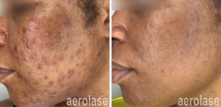 NeoClear laser acne treatment for hyperpigmentation before and after on skin of color - with reduced lesions and dark spots.