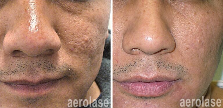 Before and after Aerolase laser for acne scars—smoother skin texture around the cheeks and nose