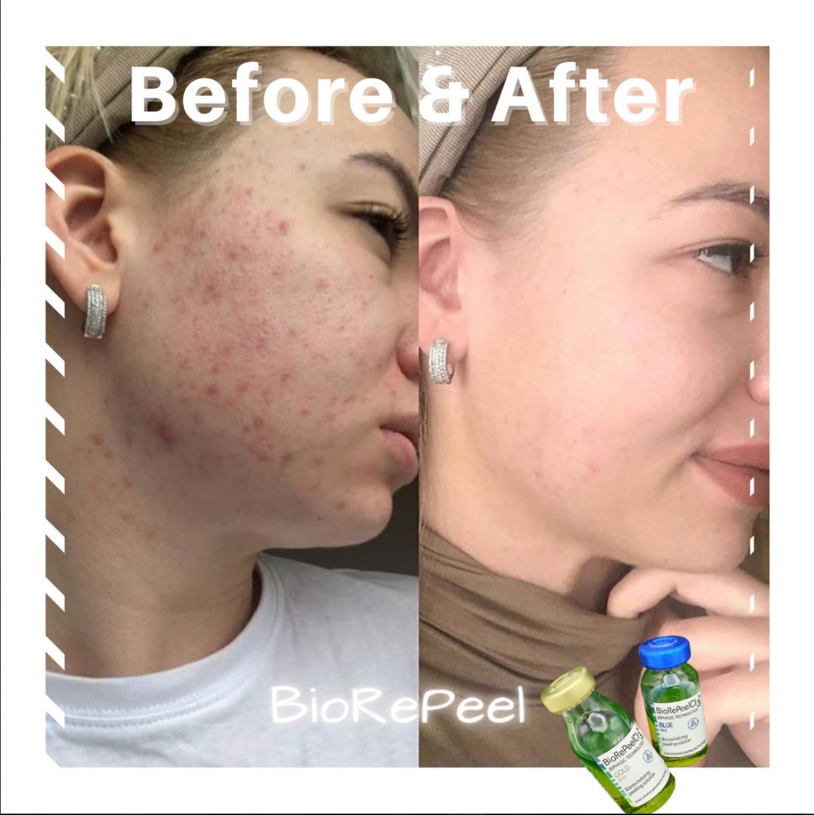 Before and after BioRePeel TCA peel for acne and skin texture improvement at Spa La La in Austin