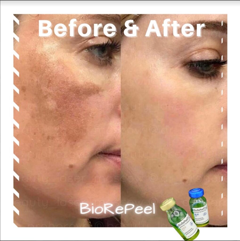 Before and after BioRePeel TCA peel for hyperpigmentation and discoloration at Spa La La in Austin