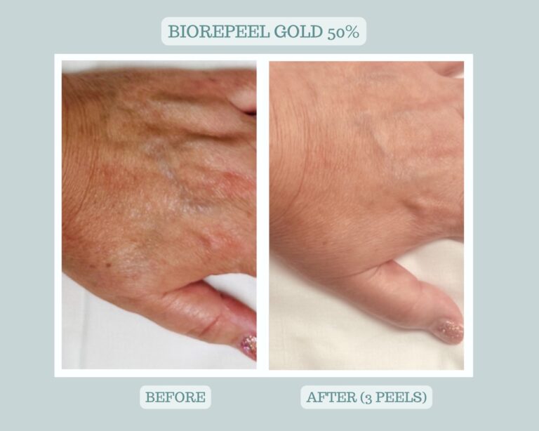 Biorepeel Gold Hands Before and After Austin