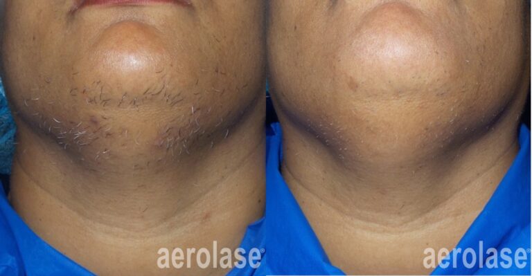 Before and after Aerolase Neo laser hair removal on chin showing reduced hair growth and smoother skin.