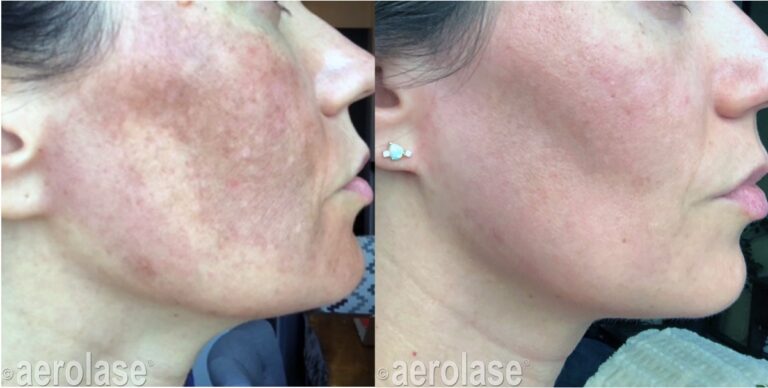 NeoSkin laser treatment for melasma and pigmentation before and after pics at Spa La La in Austin