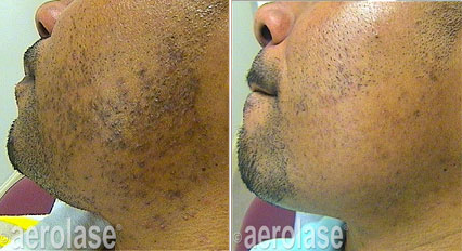 Before and after Aerolase Neo PFB treatment on the neck showing smoother skin and reduced razor bumps