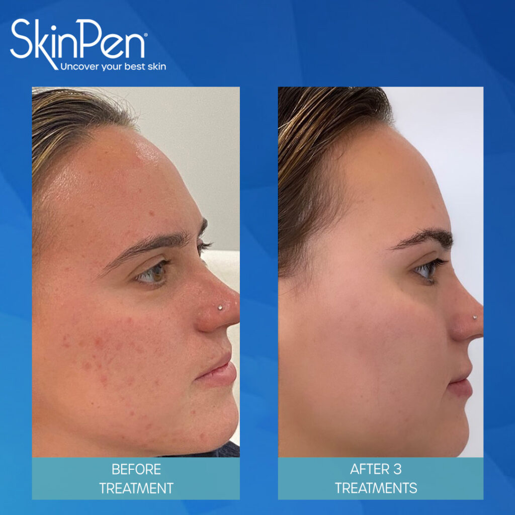 SkinPen Microneedling before and after 3 treatments for acne and texture