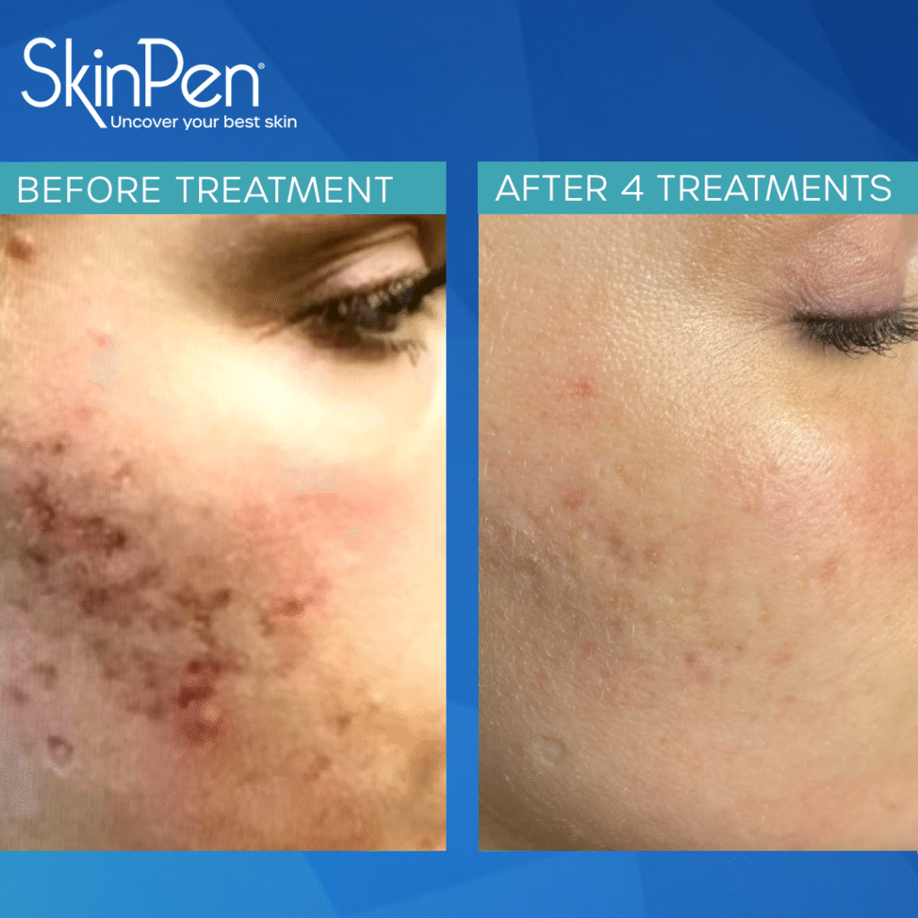SkinPen microneedling before and after 4 treatments for acne scars on cheek.