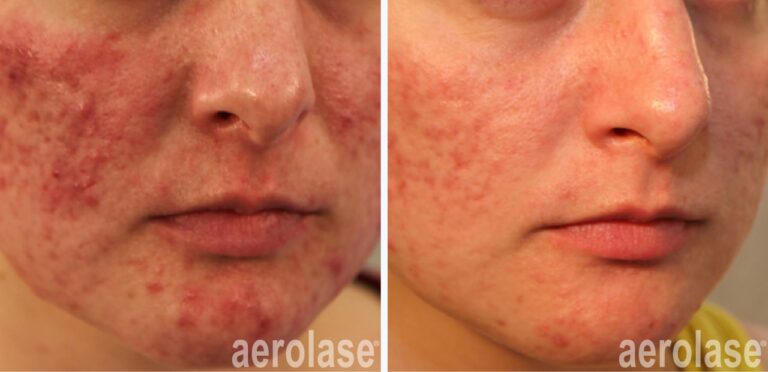 Before and after NeoClear laser for inflamed acne—calmer, clearer skin with reduced redness