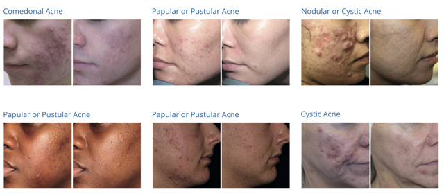 Before and after results of NeoSkin laser acne treatments at Spa La La in Austin showing improvements for comedonal acne, papular acne, pustular acne, nodular acne, and cystic acne