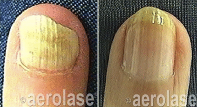 Nail fungus before and after laser treatment at Spa La La in Austin showing clearer, healthier nails”