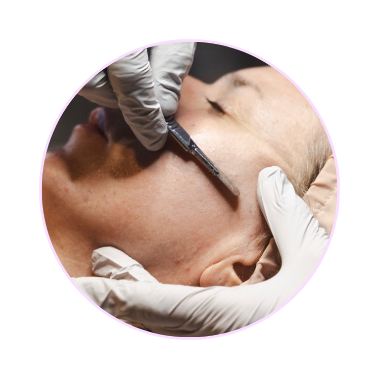 Dermaplaning