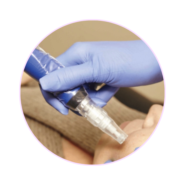 SkinPen Microneedling